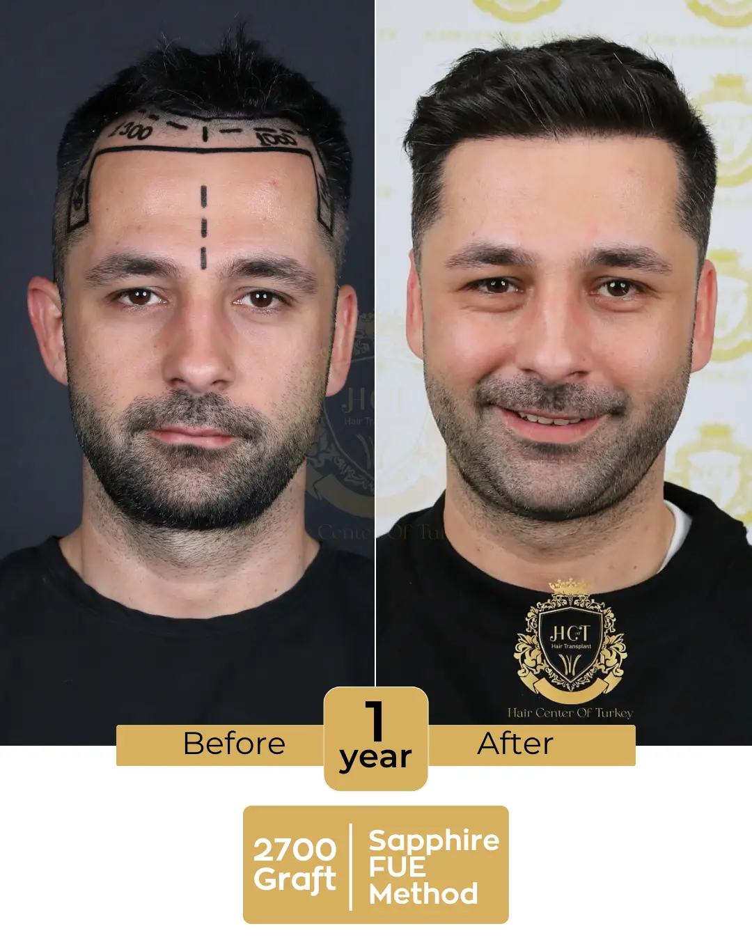 haircenterofturkey-hair-transplant-before-and-after-results-2026-09