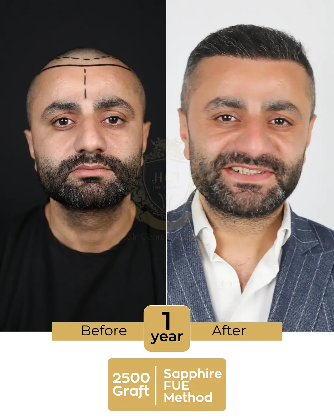 hair transplant before and after images