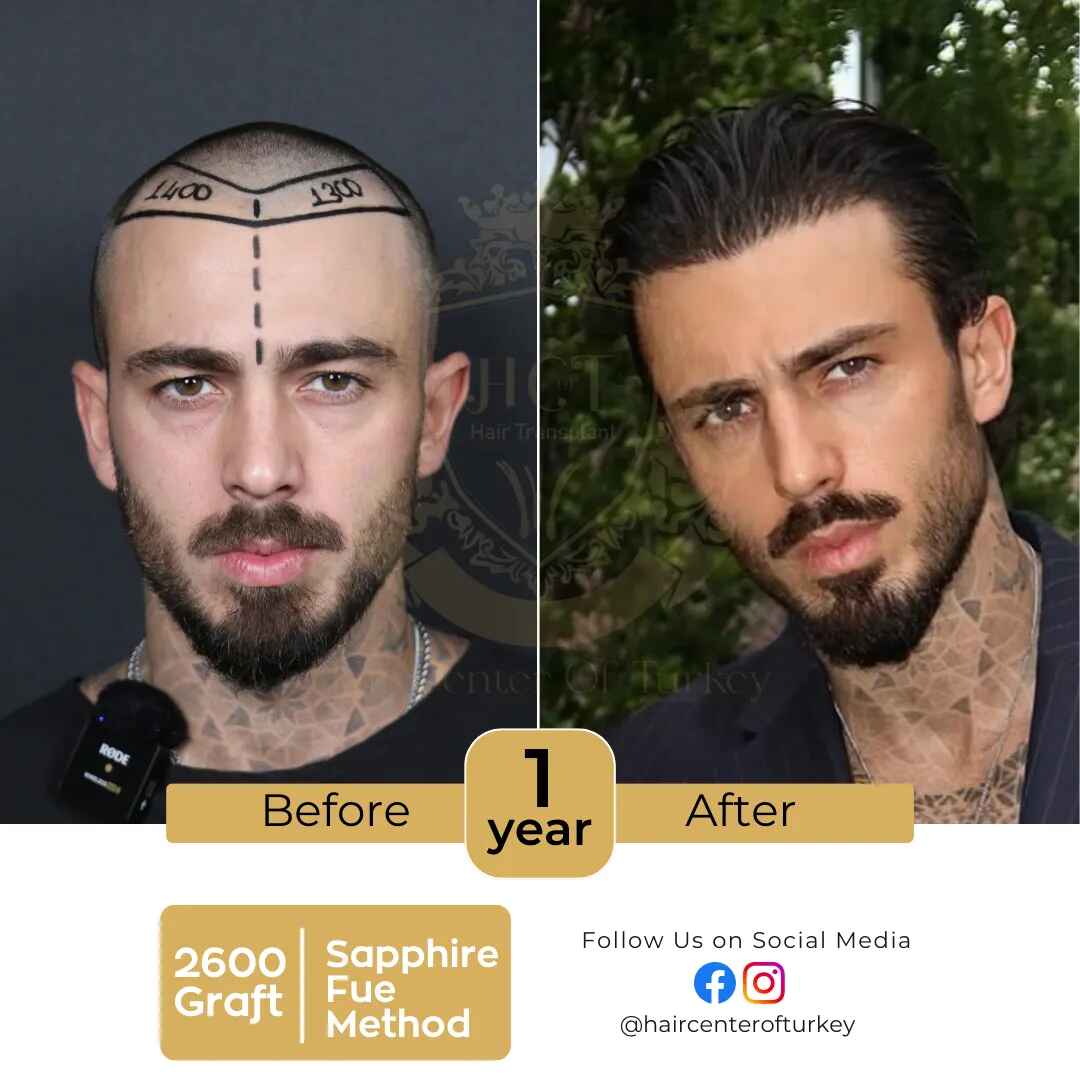 hair transplant Turkey