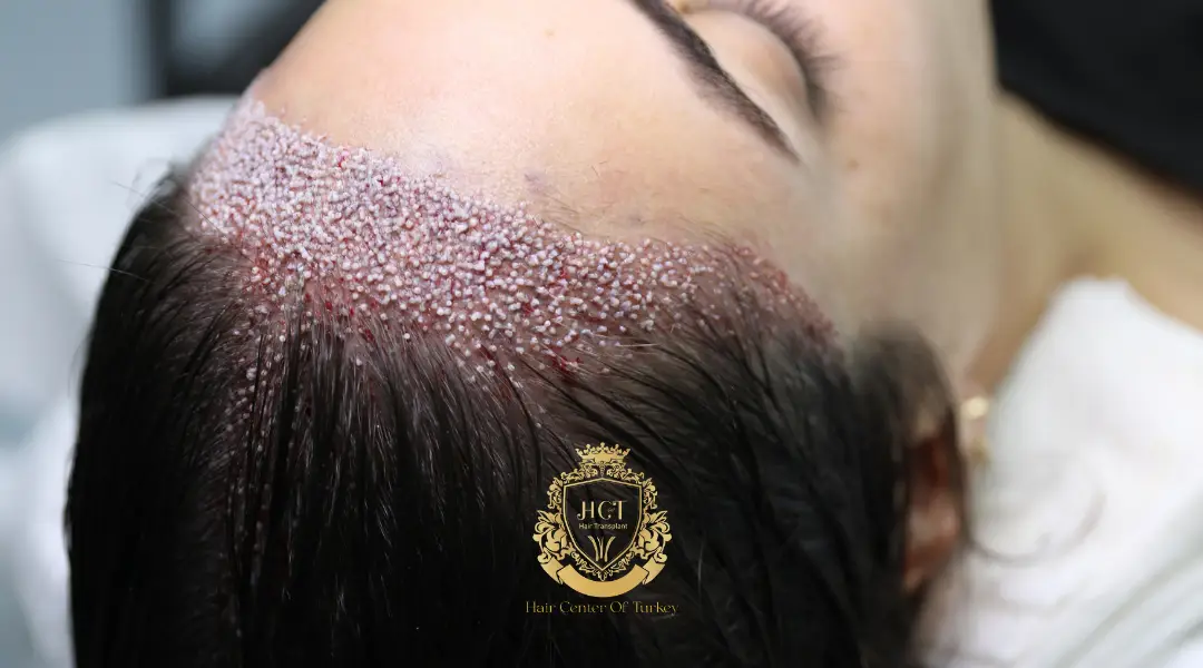 hybrid woman hair transplant in turkey