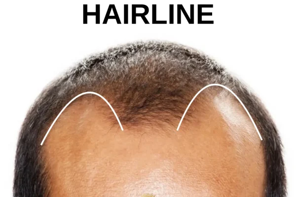 Was ist ein M-förmiger Haaransatz?