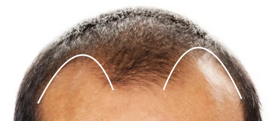 m shape hairline