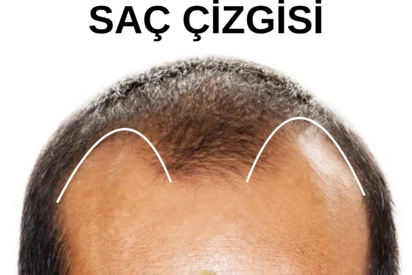 M şeklinde saç çizgisi nedir?