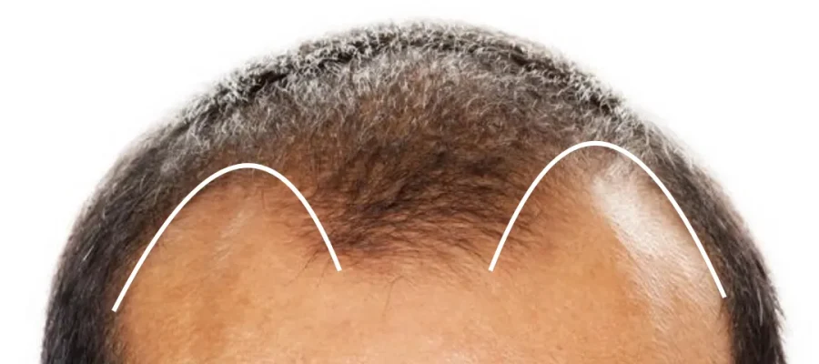 m shape hairline|m şekilli saç çizgisi