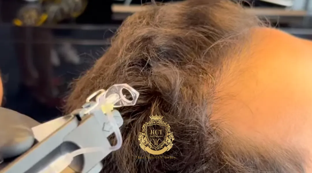 machine gun mesotherapy