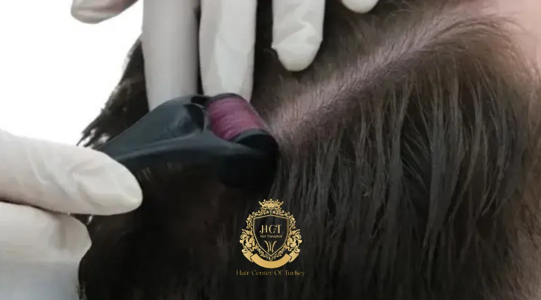 mesotherapy dermaroller