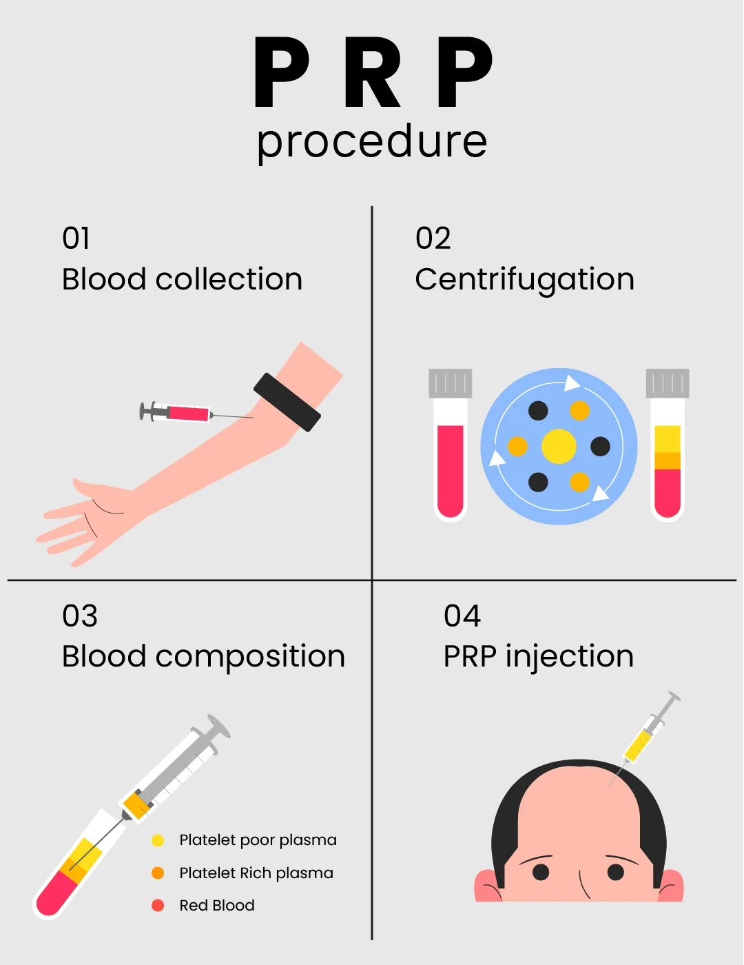 PRP (plättchenreiches Plasma) zur Haarbehandlung 3 PRP (plättchenreiches Plasma) zur Haarbehandlung