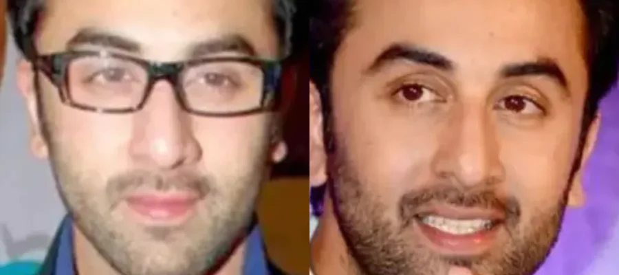 ranbir kapoor hair transplant before after|ranbir kapoor sac ekimi oncesi ve sonrasi
