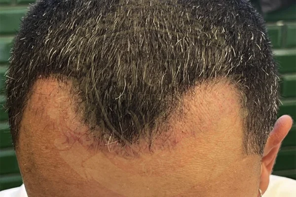 Shock Loss After Hair Transplant