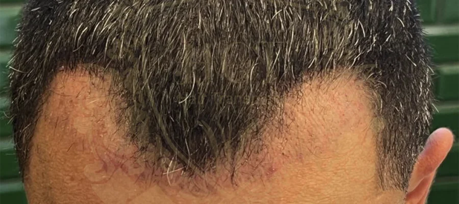 Shock Loss After Hair Transplant