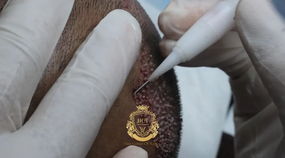 what is a dhi hair transplant