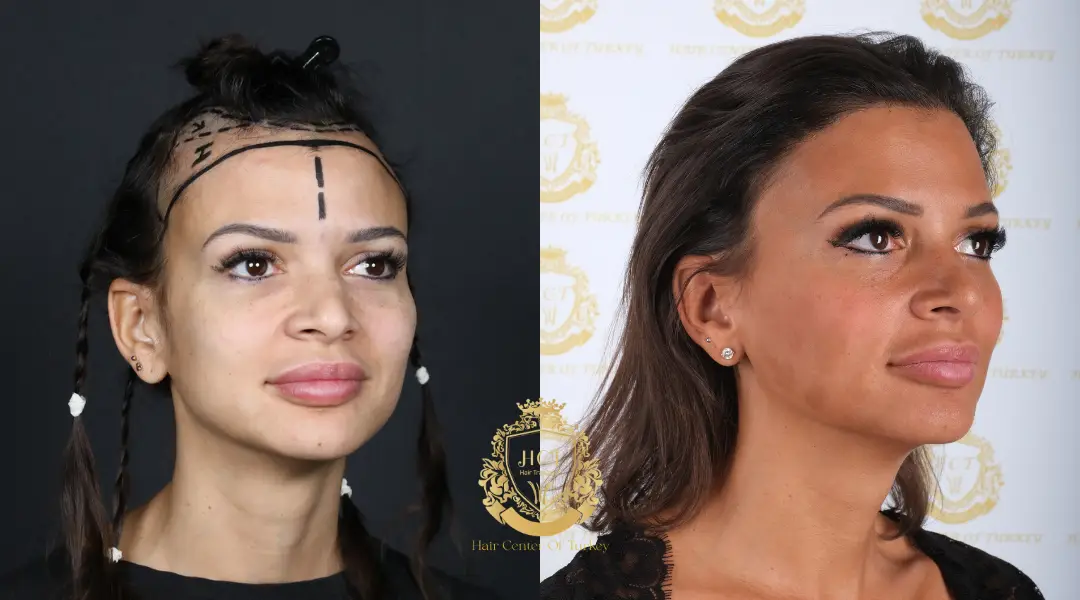 women hair transplant before and after