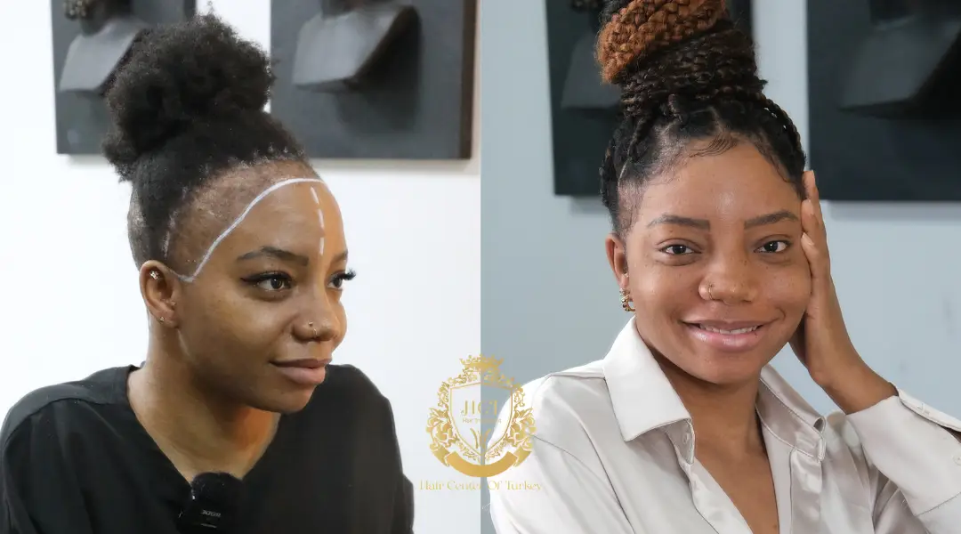 women hair transplant before and after