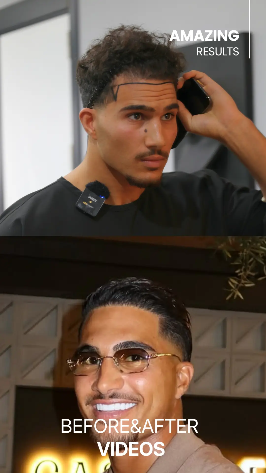 youtube-shorts-hair-transplant-before-and-after-hair-center-of-turkey (2)