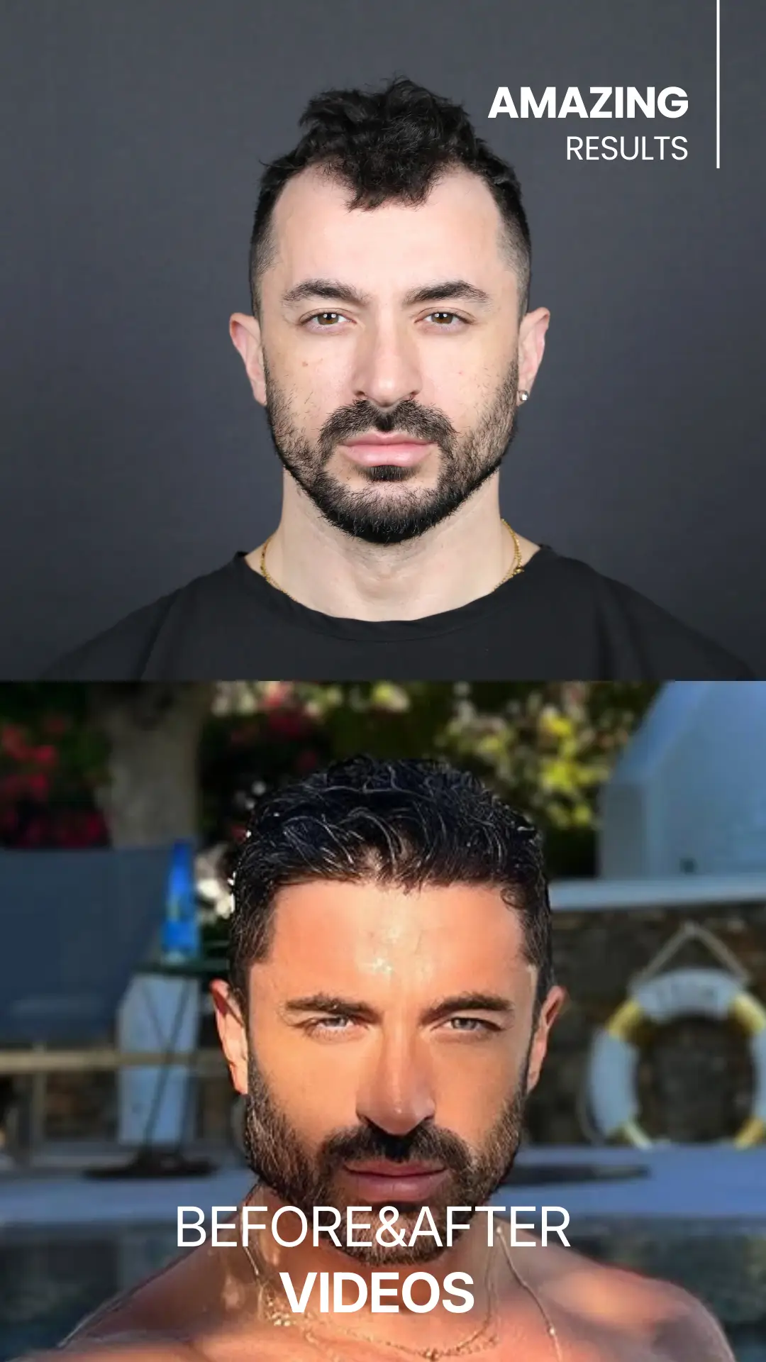 youtube-shorts-hair-transplant-before-and-after-hair-center-of-turkey (3)