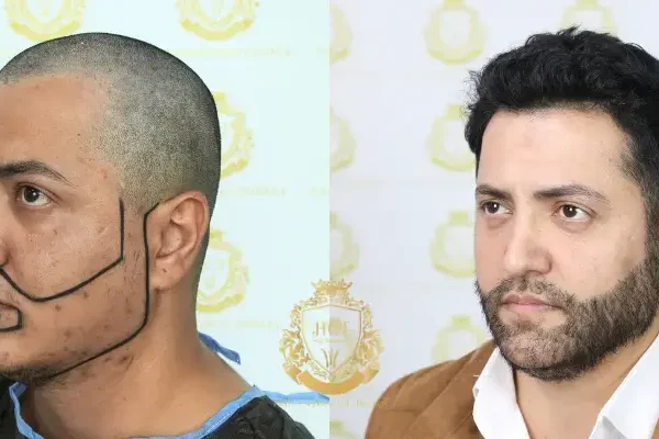 Spezielle Haartransplantation Für Transgender-patienten