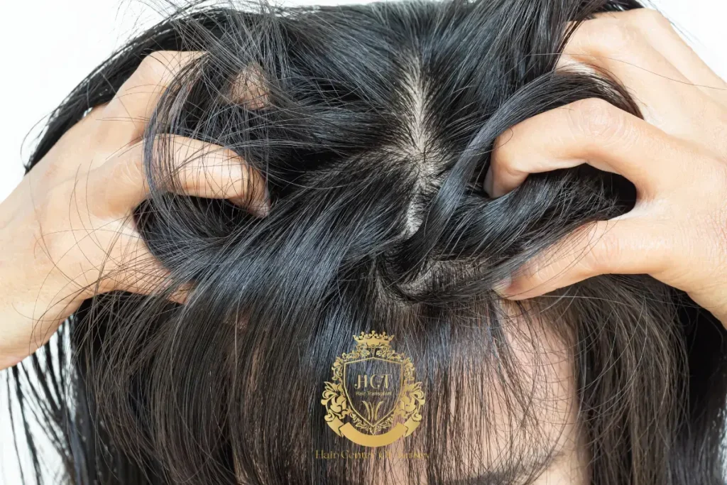 Are There Any Side Effects of Finasteride and Minoxidil?