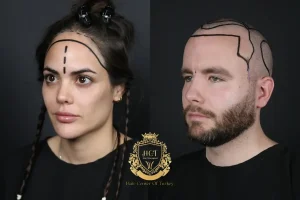 Hairline Design Feminization Vs. Masculinization
