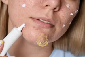 Wie wirkt Winlevi bei Akne?