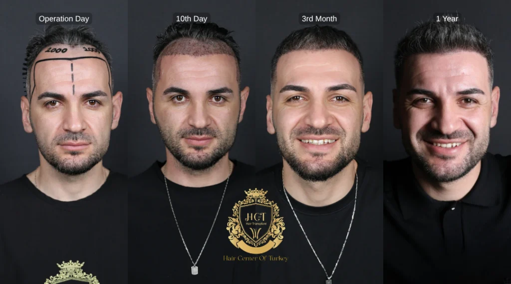 İstanbul Yenibosna'daki Saç Ekimi Klinikleri