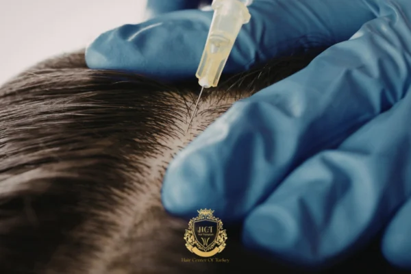 Saç Dökülmesine Karşı Ekzozom Tedavisi