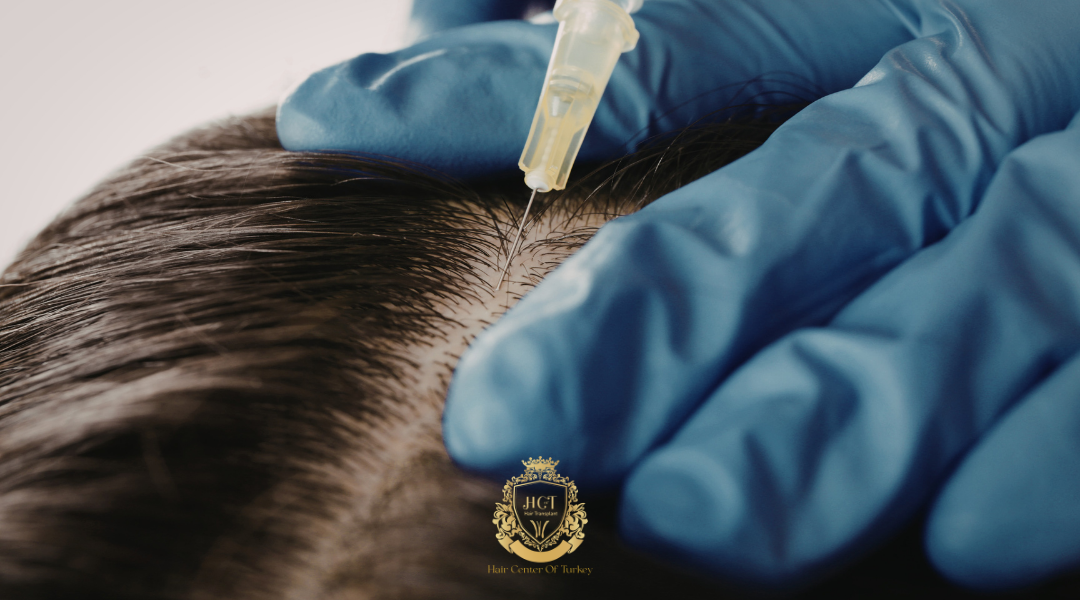 Saç Dökülmesine Karşı Ekzozom Tedavisi