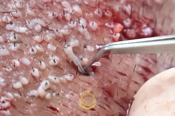 Haartransplantationskliniken in Bakırköy, Istanbul