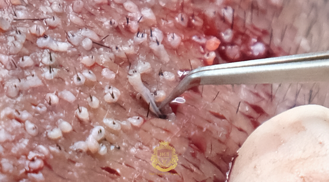 Haartransplantationskliniken in Bakırköy, Istanbul