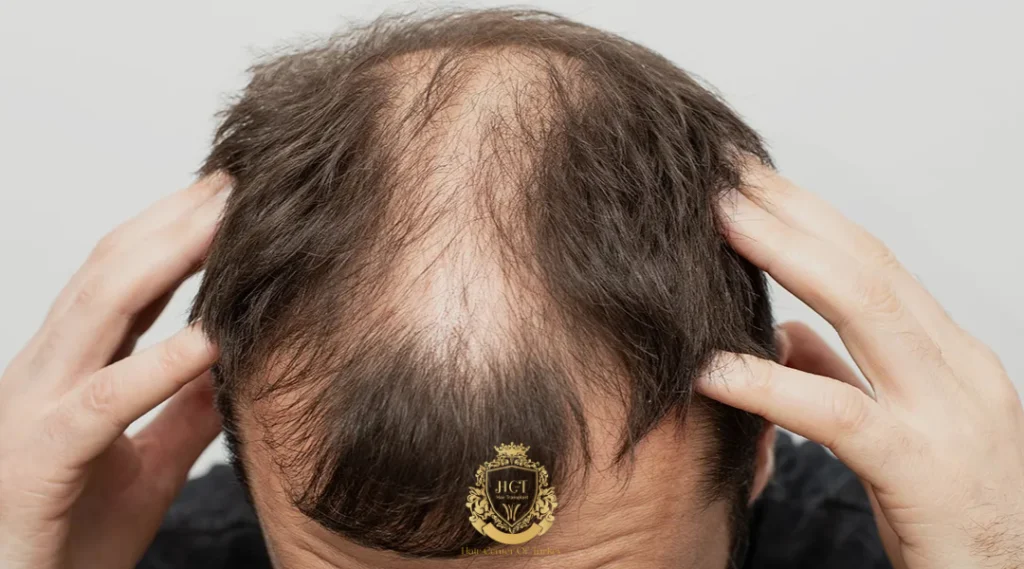 Hair Transplant in Washington 2 Hair Transplant in Washington