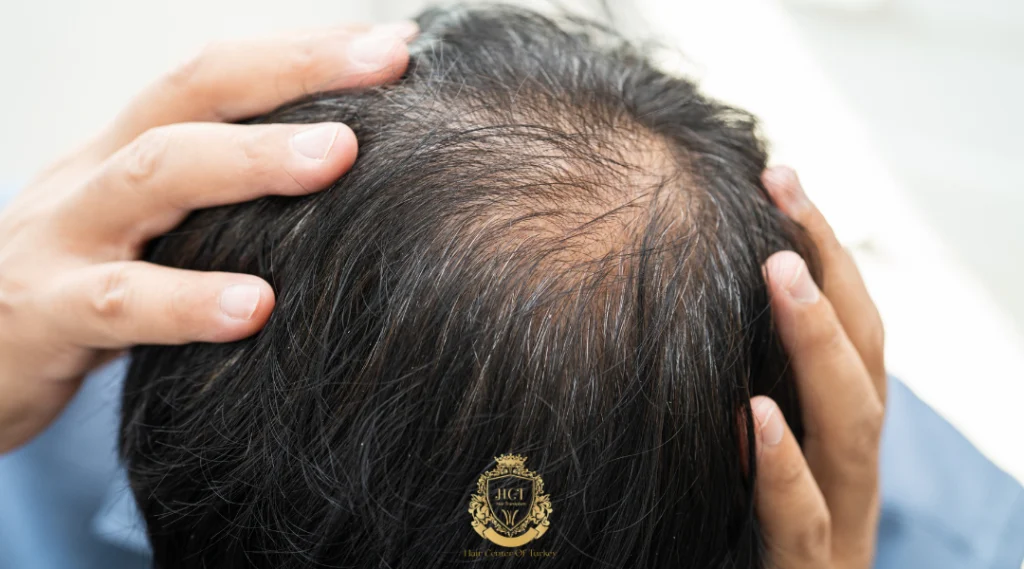 Clínicas de trasplante capilar en Sefaköy, Estambul