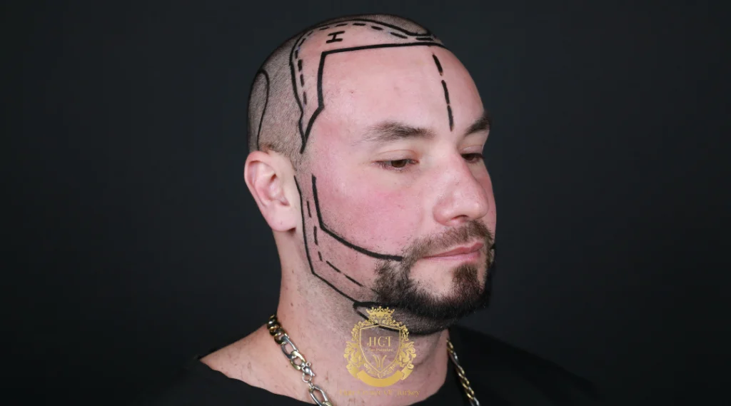 What Are the Hair Transplant Methods in Birmingham?