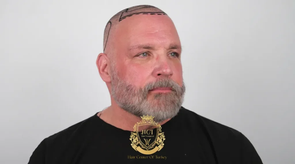 So erkennen Sie, ob Sie ein guter Kandidat für eine Haartransplantation sind