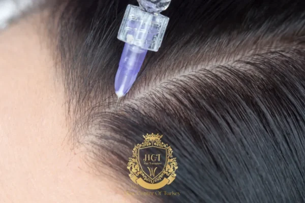 Y a-t-il des risques liés à la thérapie capillaire par exosomes ? Regard honnête