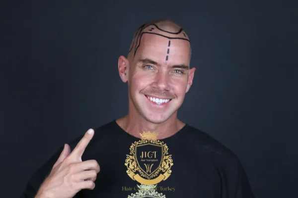 Body Hair Transplant: Is It Really Possible?