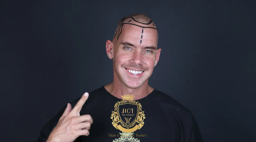 Body Hair Transplant Is It Really Possible