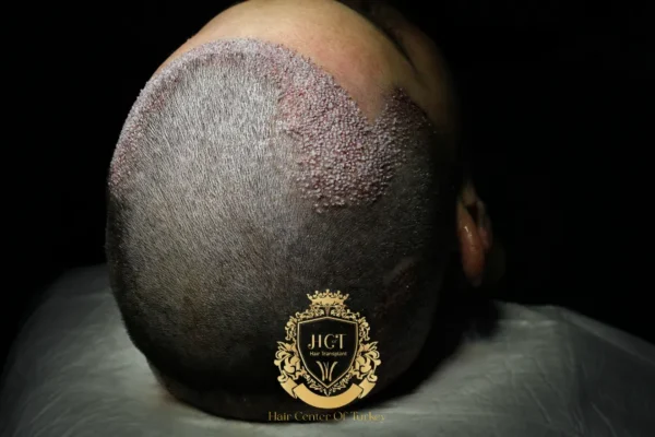 La greffe de cheveux provoque-t-elle le cancer ? La vraie réponse