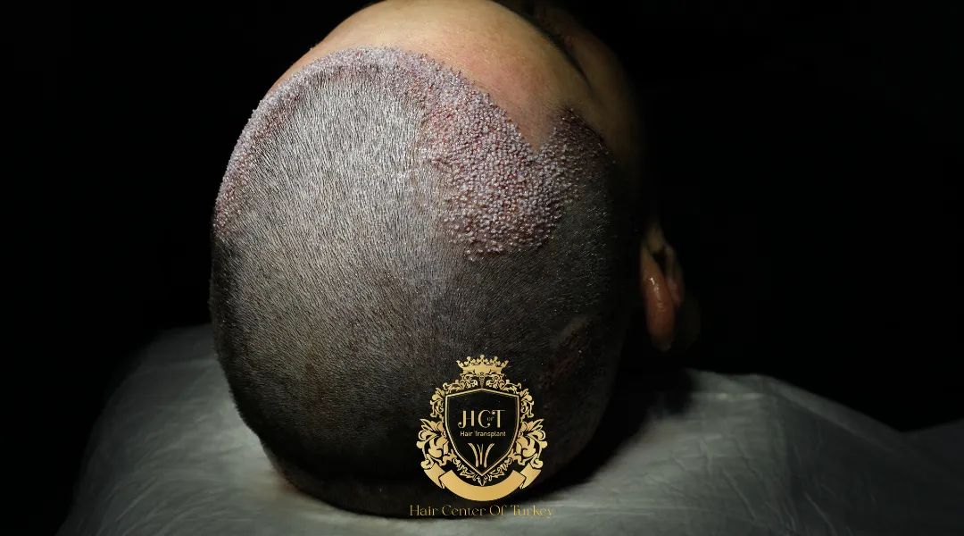 Does Hair Transplant Cause Cancer