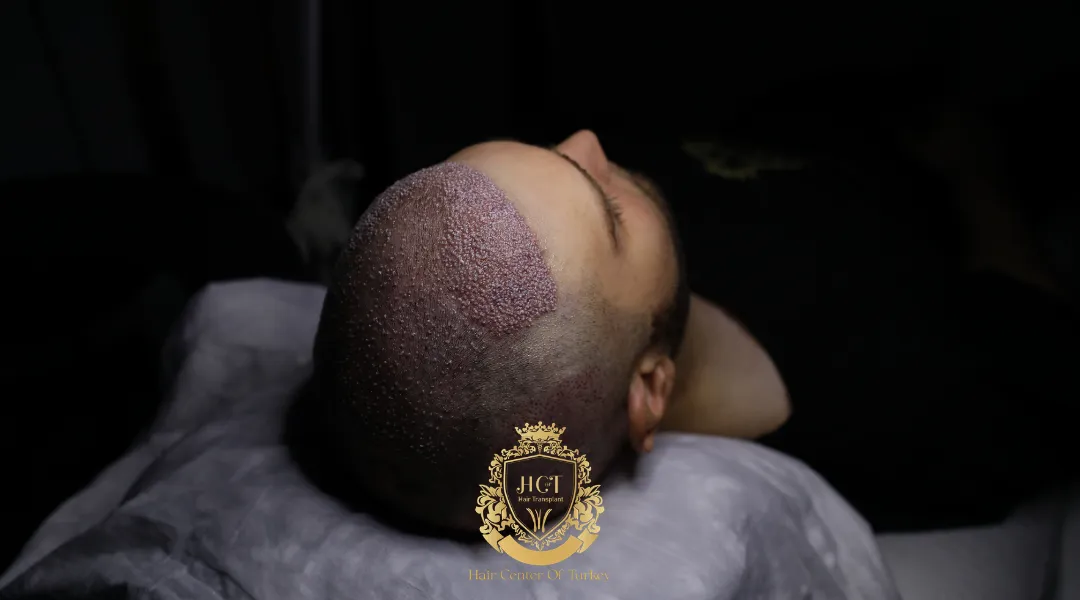 Recibir un golpe en la cabeza después de un trasplante de cabello