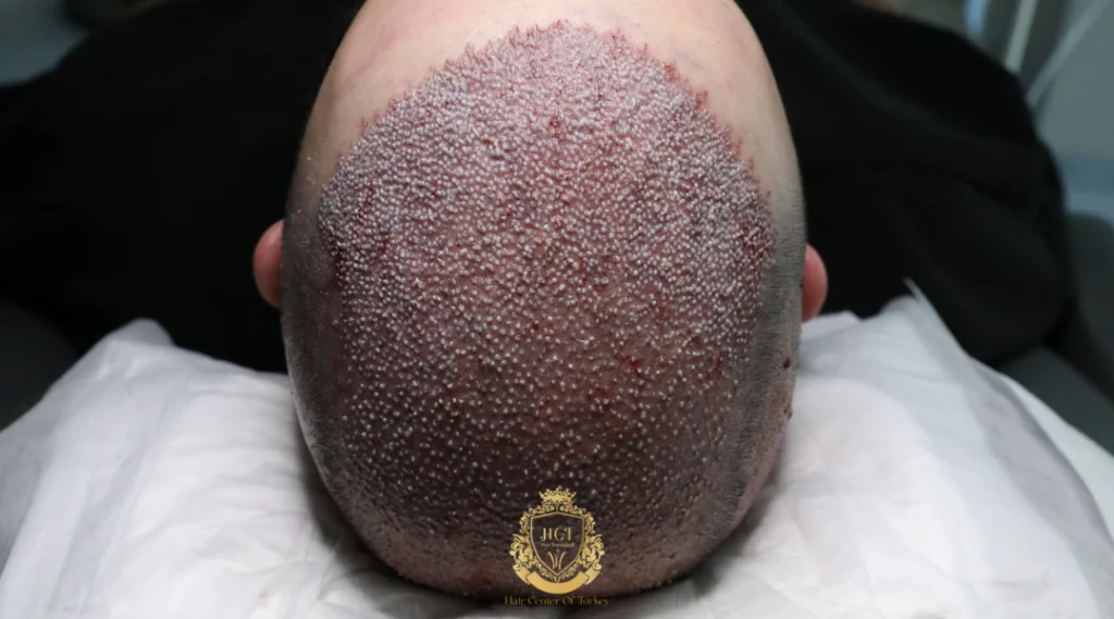 Quels sont les facteurs qui influencent le coût d'une greffe de cheveux à Londres ? 2 Le nombre de greffons ne représente qu'une partie du devis