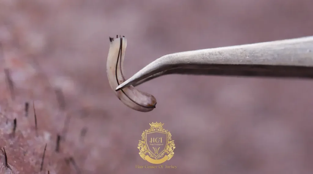 Preise für Haartransplantationen in Sisli