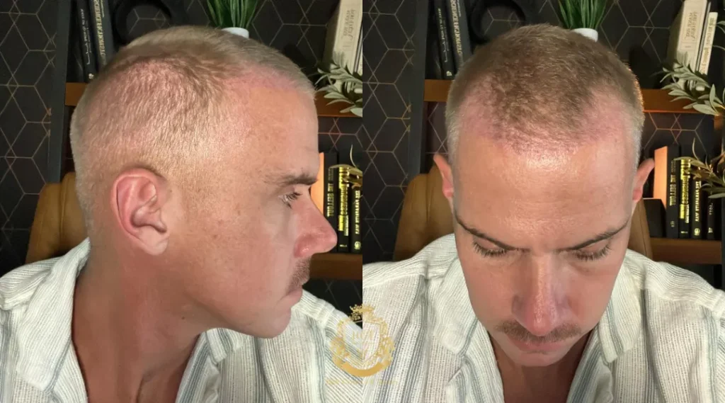 Hair Transplant Recovery Is Part of the Treatment