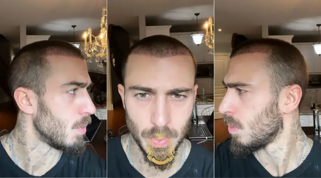 Saç Ekimi Sonrası Serum Kullanılmalı Mıdır?