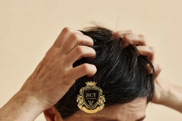 Hoe lang duurt jeuk na een haartransplantatie?