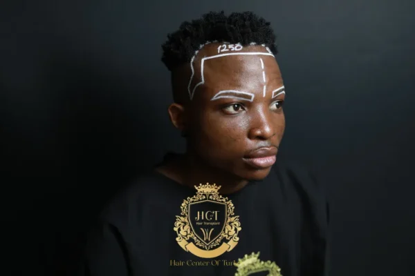 How to Choose the Donor Area for an Afro Hair Transplant