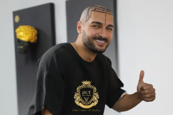 So erkennen Sie, ob Sie ein guter Kandidat für eine Haartransplantation sind