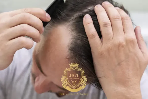 How to Prevent Hair Loss at a Young Age