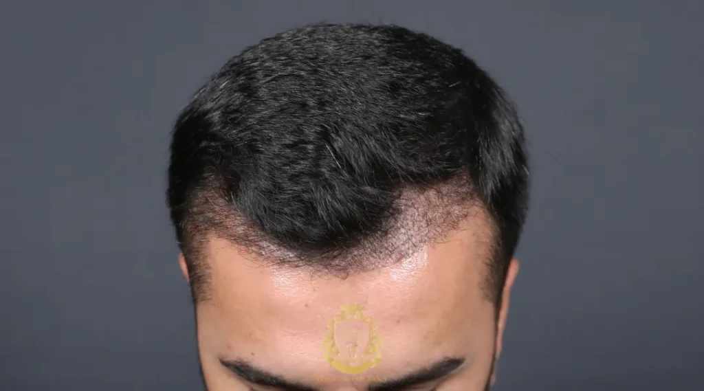 İyileşme Sürecini Mevsim Nasıl Etkiler