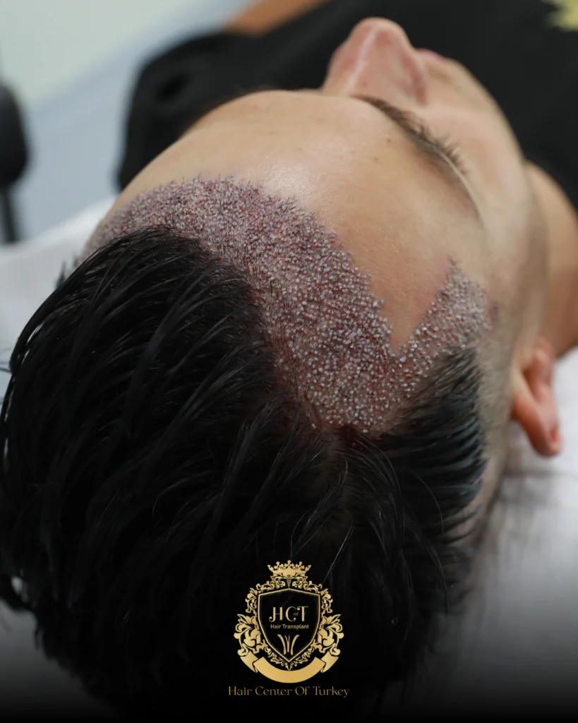 Traitement de greffe de cheveux à Edirne 2 Le prix est-il le seul critère à prendre en compte lors du choix d'une clinique de greffe de cheveux