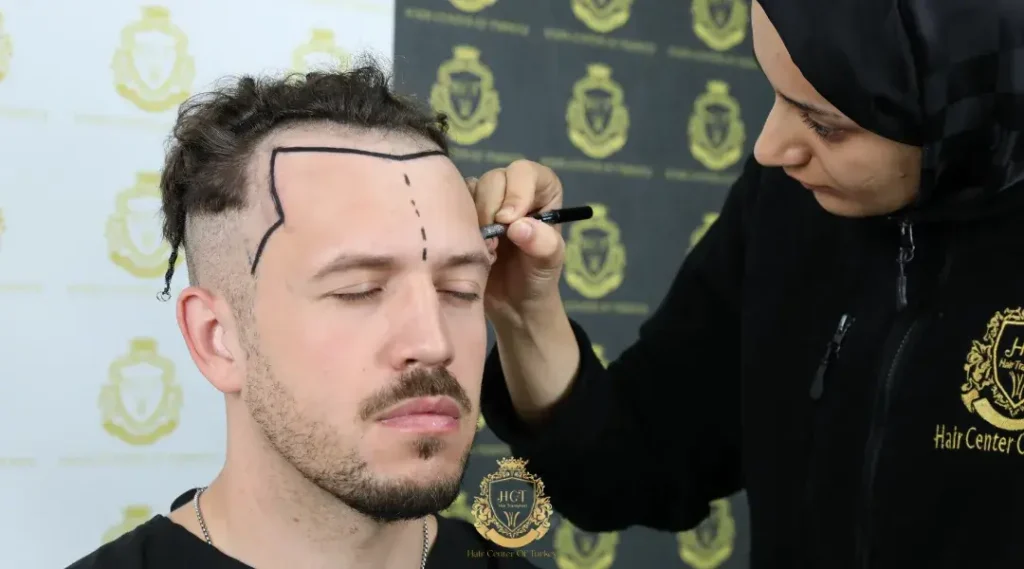 Perché scegliere Hair Center Of Turkey per il trapianto di capelli?