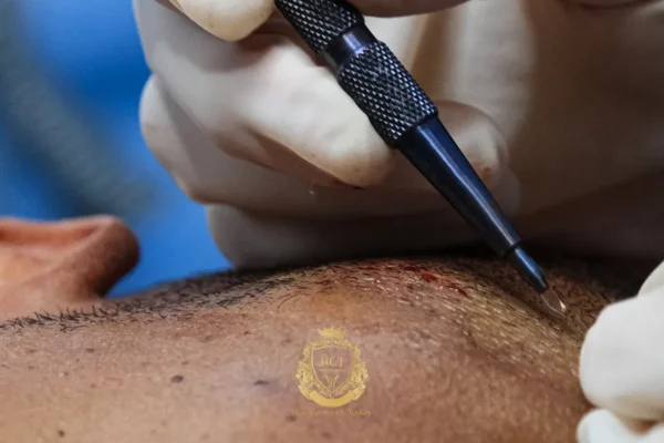 Percutaneous Hair Transplant Graft Survival Rate